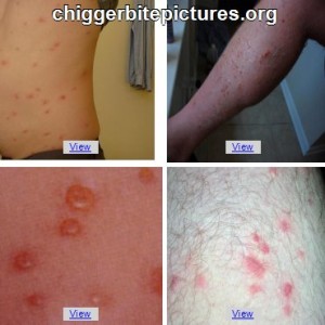 chiggerbitepictures.org